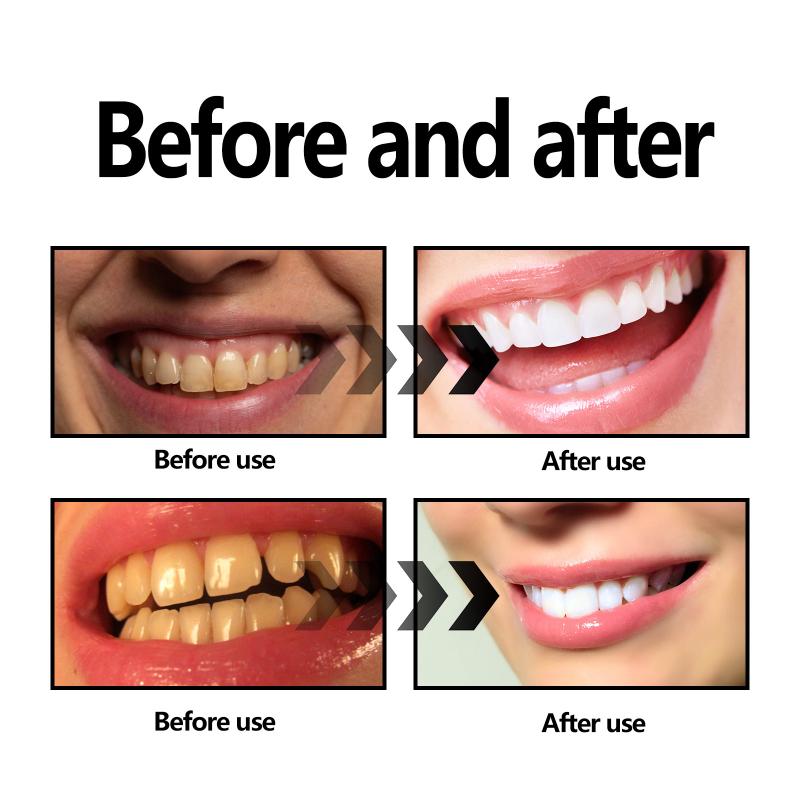 歯のホワイトニングパウダー チャコール/重曹歯のホワイトニン - Teeth Whitening Charcoal Powder のレビューと価格