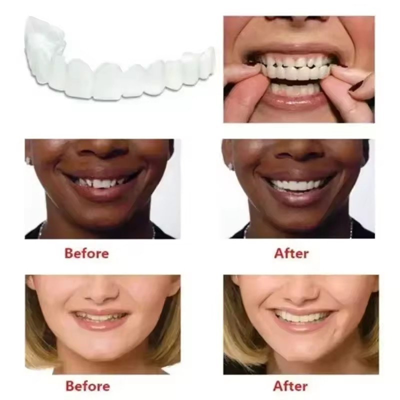 歯のベニア、ホワイトニング、入れ歯、歯列矯正、一時的な義歯カ - Teeth Whitening For Braces のレビューと価格