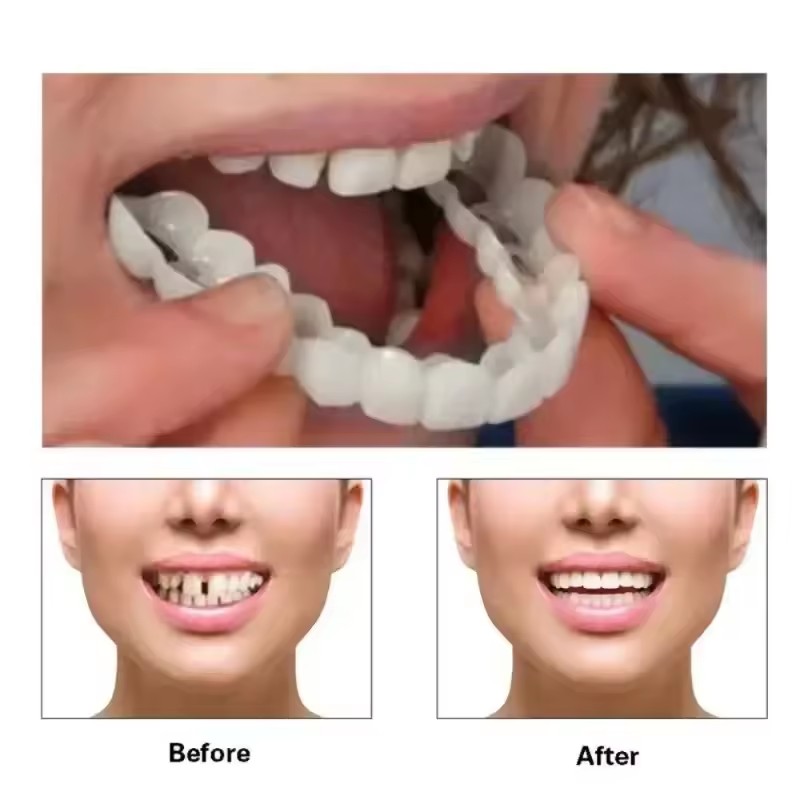 歯のベニア、ホワイトニング、入れ歯、歯列矯正、一時的な義歯カ - Teeth Whitening For Braces のレビューと価格