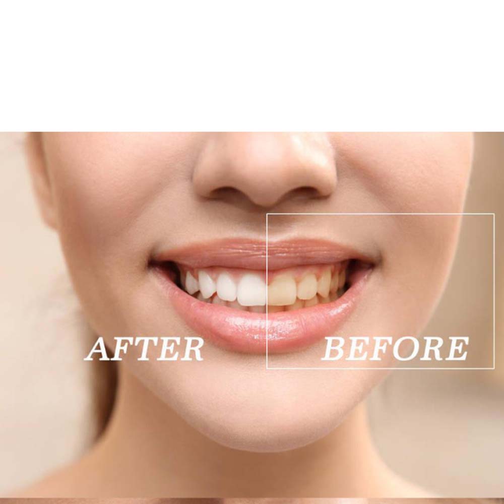 歯のホワイトニングキット,高品質の製品,過酸化物,明るい白, - Teeth Whitening Led Kit のレビューと価格