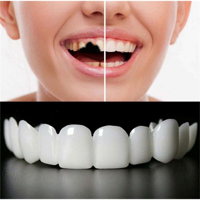 【新商品！ABMK】2ペア、美しい笑顔を取り戻す、ユニバーサ - Teeth Whitening For Braces のレビューと価格